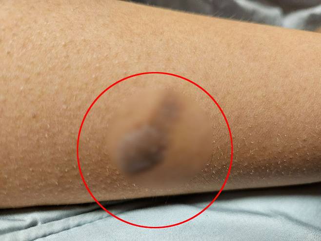 라이터로 위협당한 10살 초등학생이 팔 부위에 2도 화상을 입은 모습. 피해 아동 부모 제공