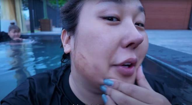 방송인 풍자가 피부과 시술 후 얼굴에 멍이 든 근황을 전했다. [사진=유튜브 채널 '풍자테레비']