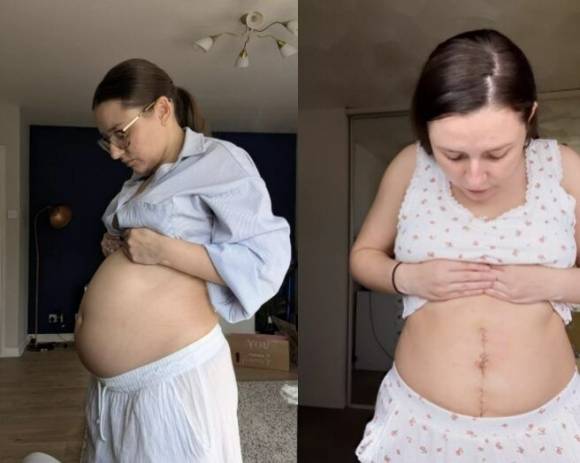 불룩 나온 배 때문에 임신 오해를 받던 영국 여성이 거대한 난소 낭종을 제거한 사연이 전해졌다. SNS 캡처