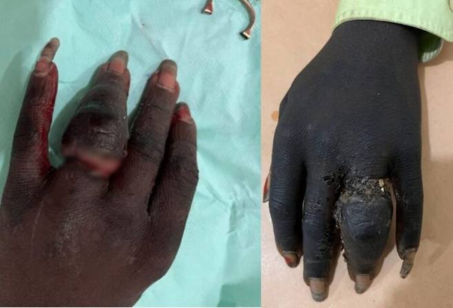 가나 출신의 20대 한 남성이 손가락에 낀 두 개의 반지 때문에 말그대로 살이 '불어 터진' 상태에 이른 사례가 공개 됐다. [사진=SNS]