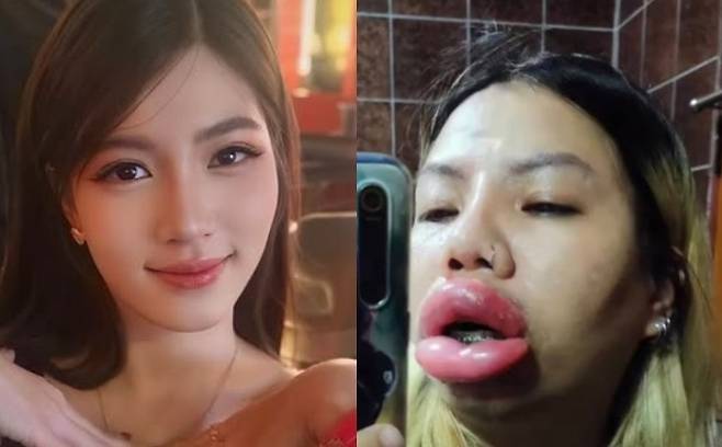 태국의 한 여성이 필러 시술 후 심각한 알레르기 반응이 일어났다며 사진을 공개해 충격을 주고 있다. [사진출처 = 메나루지 페이스북]