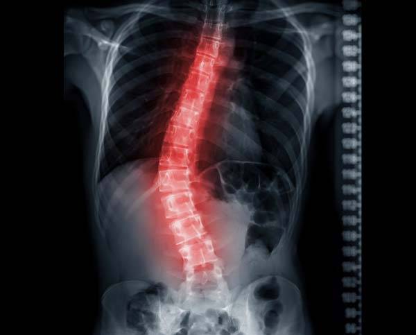 척추측만증은 몸의 중심에 일자로 서 있어야 할 척추가 옆으로 휘면서 틀어진 상태를 말한다./사진=클립아트코리아