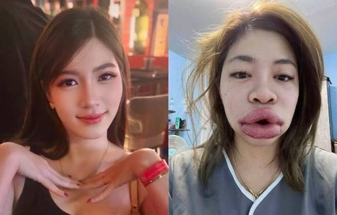 입술 필러 부작용으로 얼굴이 부어오른 태국 여성. [메나루지 페이스북]