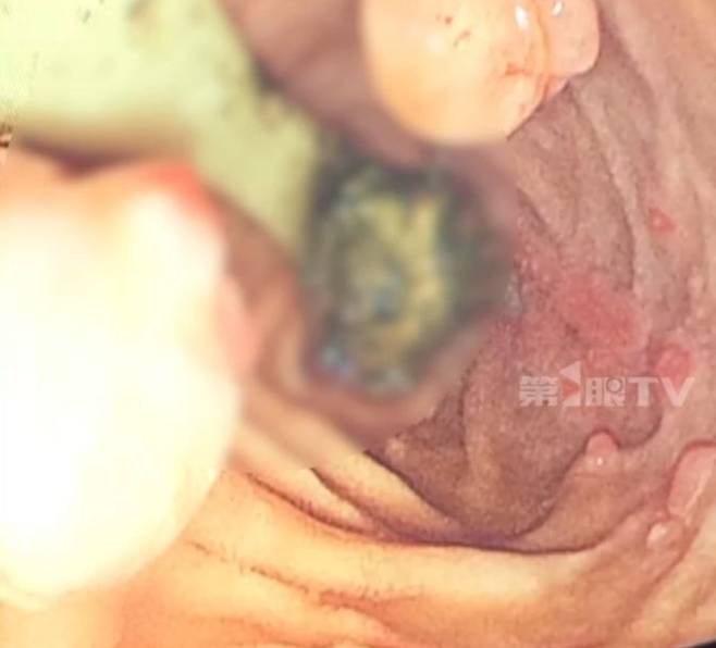 중국 안후이성 64세 양모씨의 십이지장에서 발견된 칫솔을 복강경으로 촬영한 모습. [중국왕]