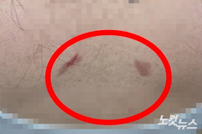 소비자 B씨는 제품 사용 직후 피부가 찢어지는 상처를 입고 흉터로 남았다고 고통을 호소했다. B씨 제공