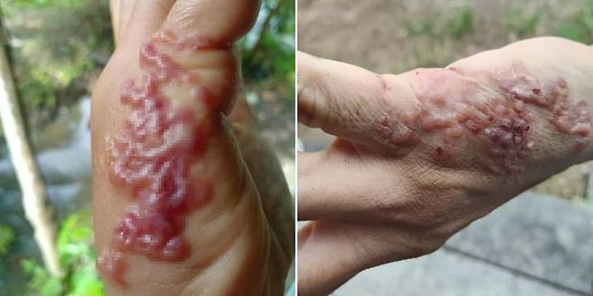 [서울=뉴시스] 태국에서 잡초를 뽑다 피부에 기생충이 침투해 손에 다발성 물집이 생긴 한 여성의 사연이 전해졌다. (사진 = 페이스북 캡처) 2025.06.17. *재판매 및 DB 금지