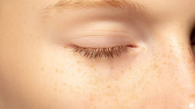 기미와 주근깨는 색소의 깊이와 치료 방법에서 차이를 보인다｜출처: 게티이미지뱅크