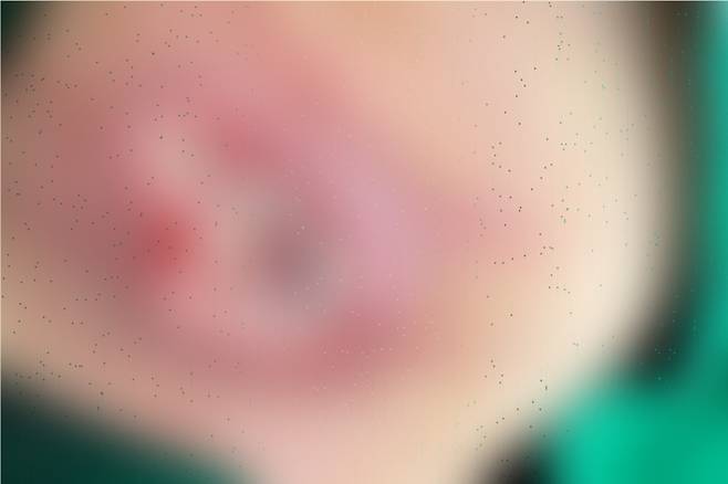 지난 1월 제품을 사용했다가 저온 화상을 입었다고 밝힌 A씨는 피부 괴사가 진행돼 괴사된 부분을 전부 긁어내는 수술을 받았다고 주장했다. SNS 캡처