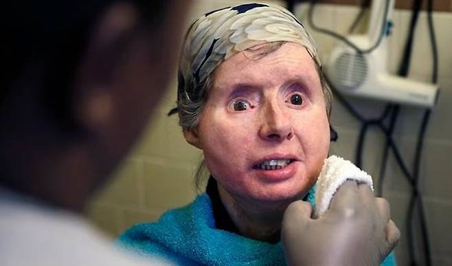 사고 후 안면 이식 수술을 받은 찰라 내시. 출처=데일리메일