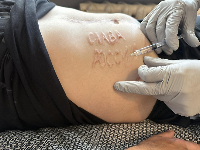 러시아에 포로로 잡혔던 우크라 군인의 배에 새겨진 ‘러시아에 영광을’ [사진 출처 = 연합뉴스]