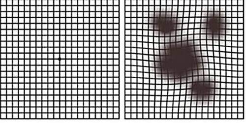 (왼쪽부터) 정상인과 황반변성 환자의 시야. (분당제생병원)