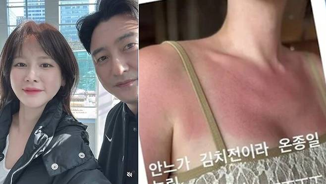 안정환 아내 이혜원이 휴가지에서 일광화상을 입었다. [사진=이혜원 SNS]