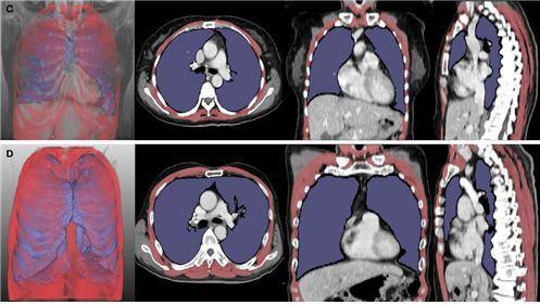 5개월(위)과 43개월(아래) 생존한 루게릭병 환자의 흉부 컴퓨터단층촬영(CT) 영상 분석 내용. 위의 환자는 폐 용적 지수(LVI·보라색)와 호흡근 용적 지수(RMI·빨간색)가 아래 환자보다 낮게 나타났다. 서울대병원 제공