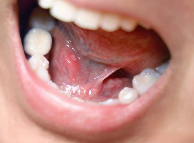 [서울=뉴시스] 한의학 전문가가 구내염과 잇몸 질환 완화에 숭늉이 도움이 된다고 밝혔다. 2025.06.23. *재배포 및 DB금지 *재판매 및 DB 금지