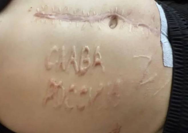 [뉴시스] 러시아에 포로로 잡혔다가 풀려난 우크라이나 군인의 복부에 '러시아에 영광을'이라는 문구가 새겨져 있었다는 사실이 알려졌다. (사진=막심 투르케비치 페이스북) *재판매 및 DB 금지