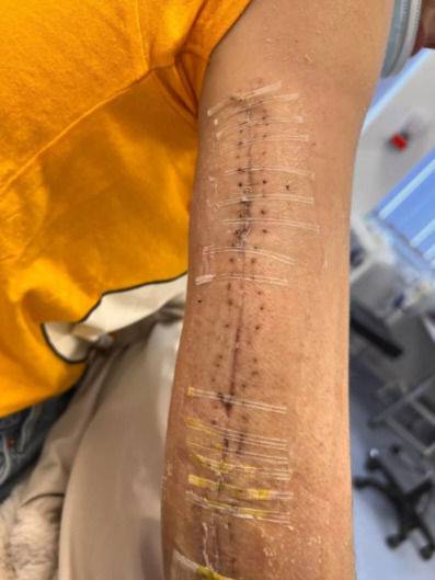 [서울=뉴시스] 영국 베드퍼드셔주 던스터블에 거주하며 빵 공장에서 근무하는 마달리나 치리카(28·여)는 지난 2023년 2월 근무 중 컨베이어 벨트에 오른팔이 끼이는 사고를 당했다. (사진=더 미러 캡처) 2025.06.23 *재판매 및 DB 금지