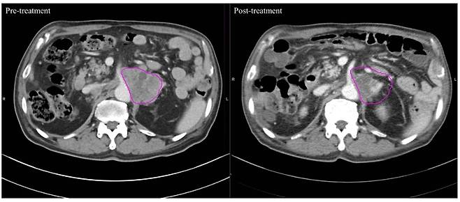 고주파 온열치료 전(왼쪽)보다 치료 후(오른쪽)암 병변 부위가 줄어든 사진. /사진=장홍석 교수 연구팀 논문 발췌