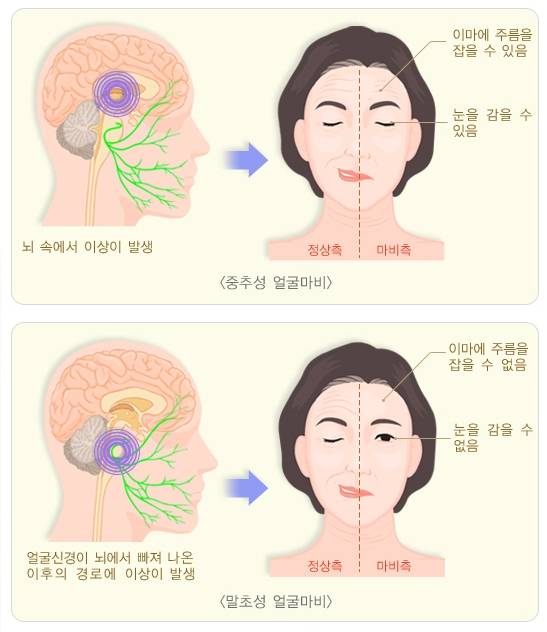 중추성 얼굴마비(위)와 말초성 얼굴마비(아래)의 특징적 증상. /자료=질병관리청 국가건강정보포털