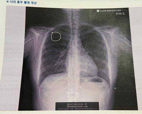 체크버스는 인공지능(AI) 기반 흉부 엑스레이 촬영과 AI 판독 리포트를 현장에서 제공하는 이동형 검진 시스템이다./사진=헬스조선DB