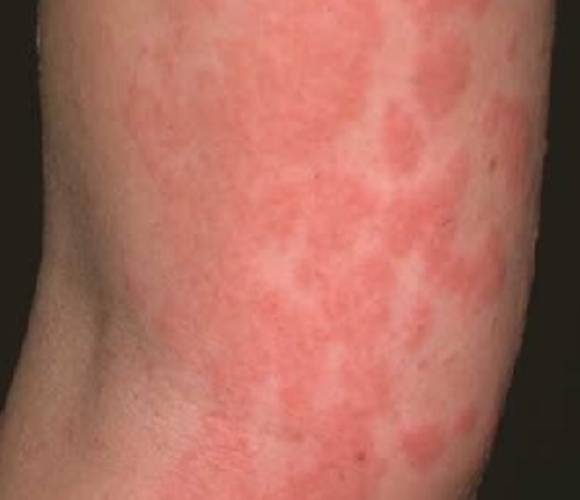 전체 인구의 약 15~20%가 일생에 한 번 이상 콜린성 두드러기를 경험하는 것으로 조사되기도 했다. 사진은 '콜린성 두드러기'가 일어난 피부. [사진=서울아산병원]