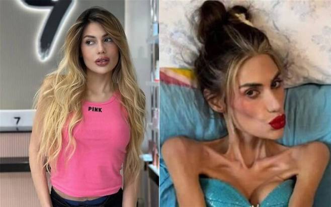 30대 터키 여성이 심각한 거식증을 앓다가 40kg 가까이 빠졌다. 결국 그는 23kg 몸무게로 사망했다. [사진=SNS]