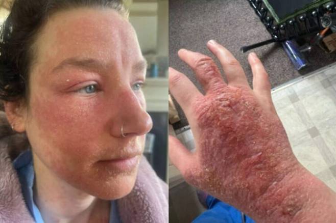 2년 전 팔꿈치에 생긴 반점 하나를 치료하기 위해 바르기 시작한 스테로이드 연고 때문에 극심한 고통을 겪고 있다는 여성의 사연이 전해졌다 [사진=SNS]