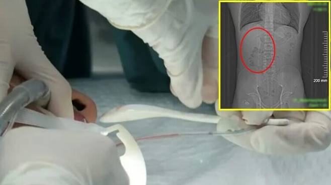 한 중국 남성이 술에 취한 상태에서 숟가락을 삼키고도 이를 꿈으로 착각한 채 5개월 동안 일상생활을 하다 최근 우연한 계기에 발견해 제거하게 된 사연이 소개됐다. [사진=SNS]