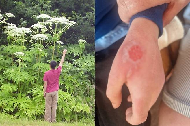 사람 키보다 높이 자라는 독성 식물 '큰맷돼지풀'(왼쪽)에 접촉해 화상을 입은 영국의 8세 소년. 사진=Central Kootenay Invasive Species Society(CKISS)/Danielle Bloomer-Rogers
