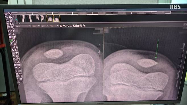 8주 진단을 받은 A 군의 무릎 엑스레이(X-ray) 사진