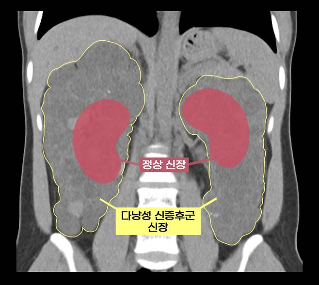 실제 다낭성 신증후군 환자의 신장과 정상 신장 비교(수많은 낭종으로 울퉁불퉁하고 크기도 비대해진 상태