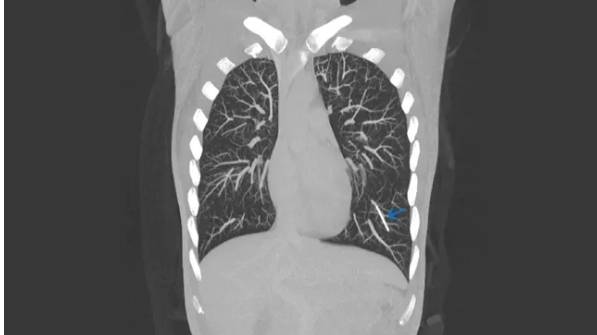 팔뚝에 삽입된 피임 임플란트가 핏줄을 타고 폐에 박혔다. CT 영상에서 왼쪽 폐 아래 파란색 화살표가 가리키고 있는 흰색 선이 피임 임플란트다.  [BMJ Case Reports 캡쳐]