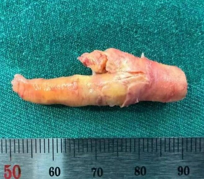 수 년간 매일 담배를 두 갑씩 피워 온 55세 남성의 경동맥에서 흡사 닭발을 연상시키는 모양의 플라크가 제거된 사연이 전해졌다. [사진=SNS]