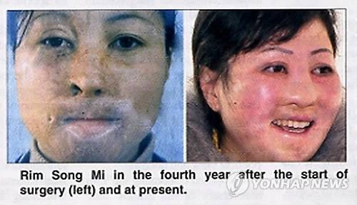 북한의 주간 영자신문이 2015년 공개한 사례. 2006년 평안북도 대관군의 공장 화재로 심각한 얼굴 화상을 당한 여성 노동자 림송미(28)가 8년에 걸친 성형수술로 외모를 회복했다. 평양타임스는 림송미의 4년 전과 현재의 얼굴을 나란히 비교하는 사진도 게재했다. 연합뉴스