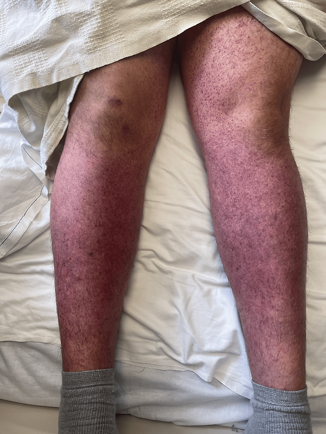 미국의 24세 남성이 정체불명의 발기부전제를 복용한 뒤 몸 곳곳에 멍이 들고, 코피와 잇몸 출혈이 멈추지 않는 등 심각한 혈액 이상 증상을 보였다. 이는 비아그라 성분이 면역성 혈소판 감소증을 유발한 첫 사례다. (사진=Cureus)