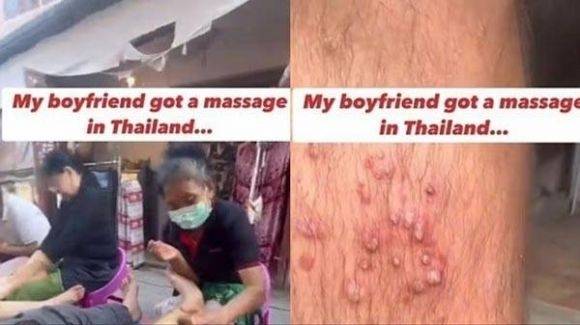 태국 여행 중 저가 마사지를 받은 뒤 다리에 심각한 염증이 생겼다는 남성의 영상이 확산하고 있다. 조 휘팅턴 박사 SNS