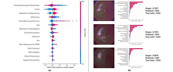 설명 가능한 AI 기법을 통한 주요 위험 인자 기여도 시각화 결과