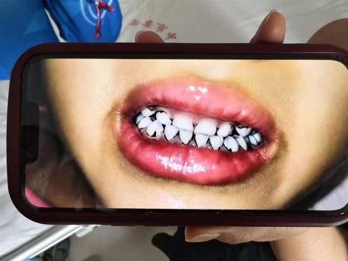 중국서 납중독 의심으로 치아 일부가 검게 변한 유치원생 /사진=연합뉴스 [중국 매체 지무뉴스 캡처. 재판매 및 DB금지]