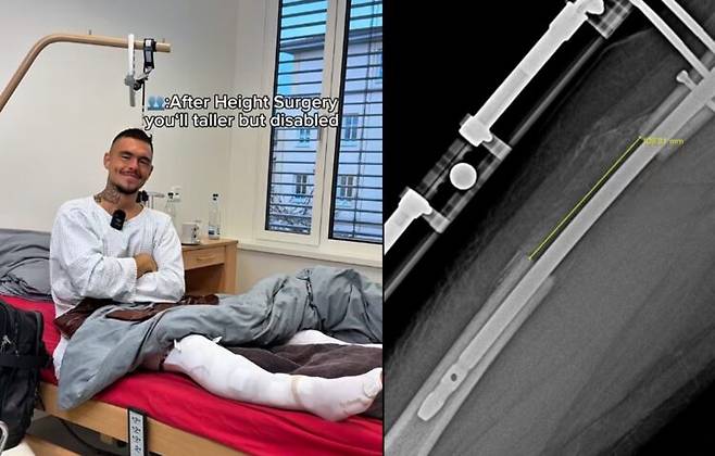 극심한 통증과 고비용이 수반되는 사지연장술은 다리뼈를 절단하고, 자석이 내장된 금속막대를 삽입한 뒤, 이를 수개월에 걸쳐 서서히 늘리는 방식으로 진행된다. 오른쪽 사진은 첫 번째 수술 후 대퇴골(허벅지뼈) 엑스레이 이미지다. [사진=SNS]