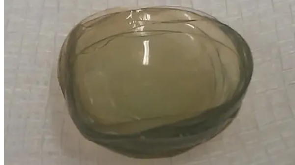 한 여성의 눈에서 콘택트렌즈 27개갸ㅏ 백내장 수술 직전에 발견됐다. 사진은 덩어리처럼 뭉친 콘택트렌즈. [The BMJ 캡쳐]