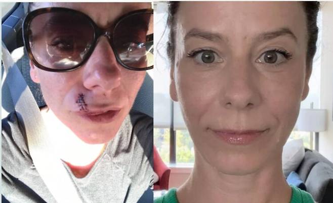 개에게 물려 입 주변에 37바늘을 꿰매야 했던 여성이 '페이스 요가(face yoga)'로 흉터를 낫게 할 수 있었다고 주장해 화제다.[사진=SNS]