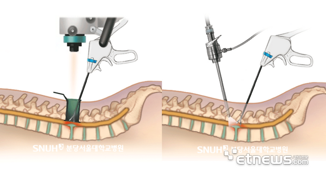 MD수술법(왼쪽)과 BED 수술법(오른쪽)