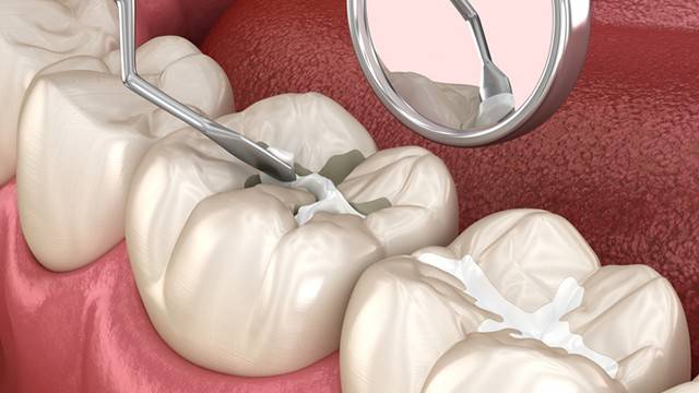 치아 손상이 적을 때는 레진 치료가 빠르고 경제적이다┃출처: 게티이미지뱅크