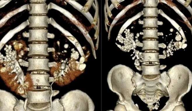A 씨의 신장을 CT 촬영한 결과물. 하노이 E병원