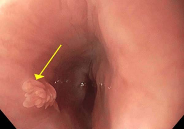 위식도 역류 증상이 낫지 않던 30대 여성의 식도에서 발견된 종양(화살표가 가리키는 곳)./사진=큐레우스