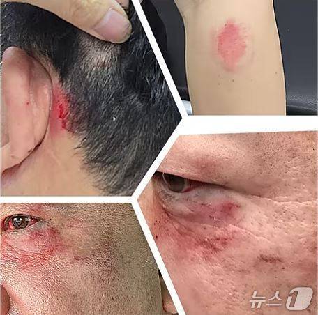 얼굴 부위에 폭행 흔적이 있는 평택지역 지방일간지 소속 기자 얼굴(유튜브 캡처)