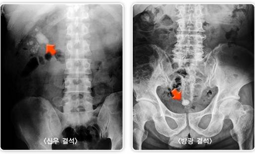 복부 방사선 촬영에서 발견한 요로결석(각 화살표 표시). /사진=국가건강정보포털