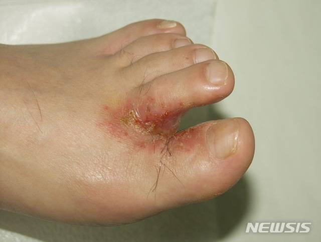 [서울=뉴시스] 날씨가 덥고 습한 여름철엔 발에서 미생물이 번식하기 쉬워 무좀(족부 백선)과 같은 피부 질환이 잘 걸린다. 사진은 족부 백선 환자의 발의 모습.(사진= 뉴시스DB) 2025.07.16. photo@newsis.com.