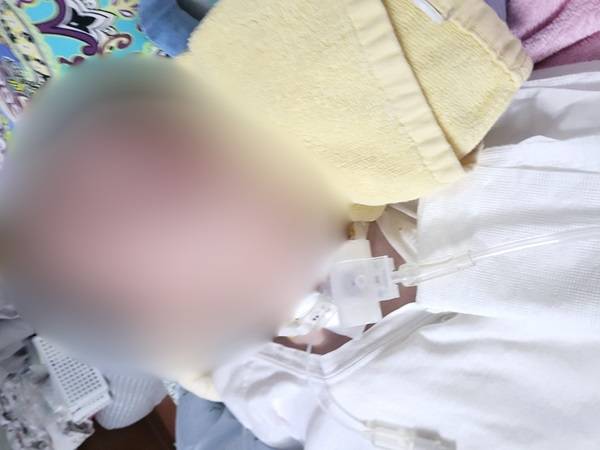 드라벳 증후군을 앓고 있는 조영준(가명·22세) 씨의 현재 모습/사진=보호자 제공