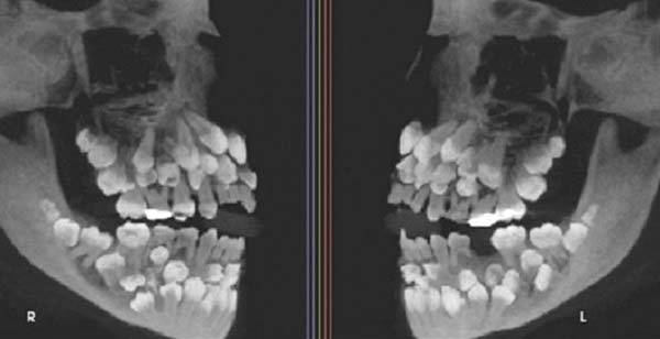 브라질의 한 11세 소녀 입안에서 무려 81개의 치아가 발견돼 화제가 되고 있다./사진=VN익스프레스