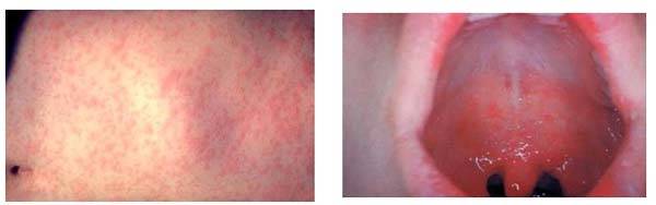 홍역 발진 및 구강 반점 사진./질병관리청 제공